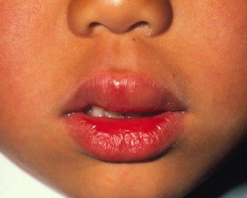 Аллергия на апельсины: симптомы у детей и взрослых