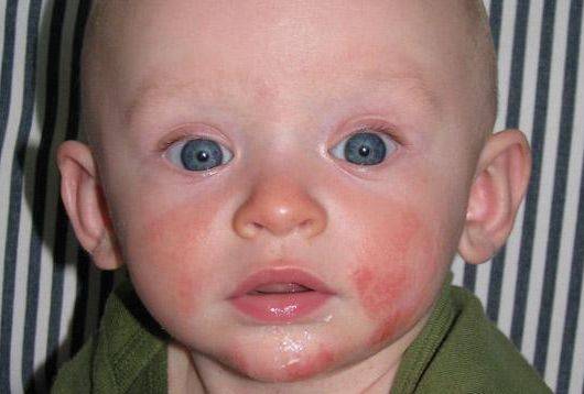 Аллергия на морковь у детей и взрослых