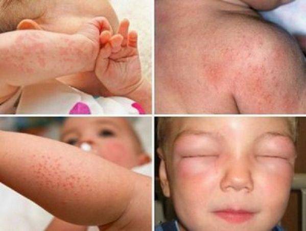 Профилактика аллергии | компетентно о здоровье на ilive