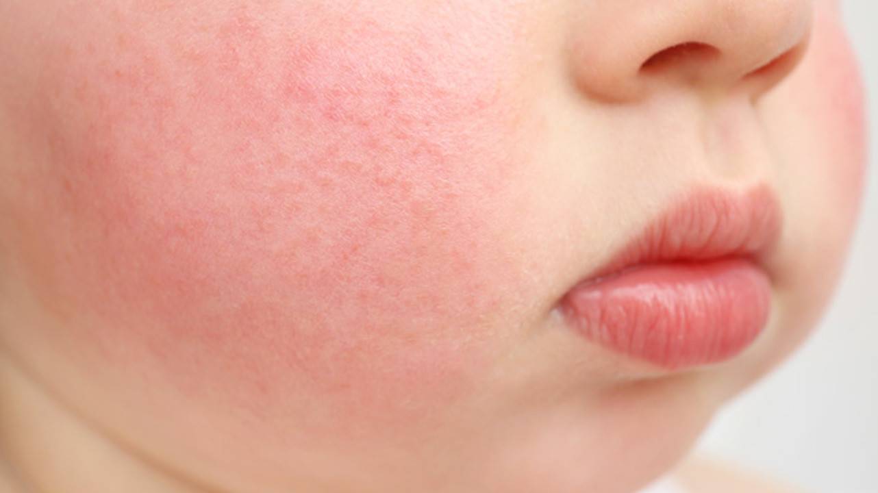 Аллергия на цитрусовые симптомы у детей фото