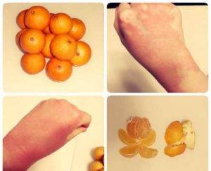 Аллергия на цитрусовые: фото, симптомы у взрослых на мандарины, апельсины, лимон