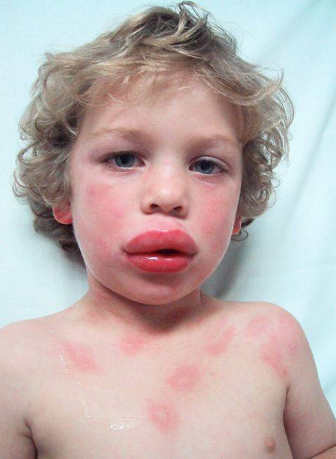 Аллергия на апельсины: симптомы у взрослых и детей, лечение