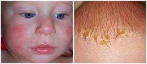 Аллергия на апельсины: симптомы у детей и взрослых, фото — selok.info