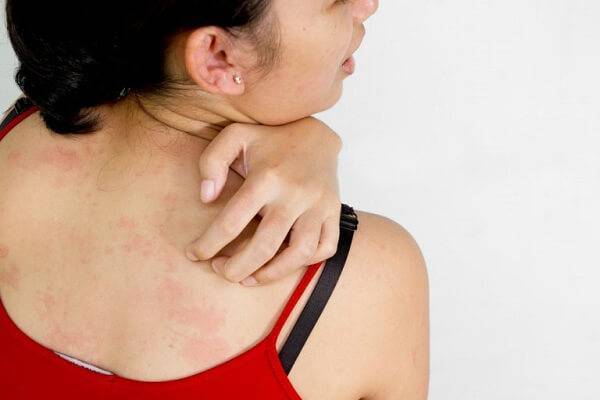 Аллергия на пыльцу (сенная лихорадка) – симптомы, лечение, советы  - причины, диагностика и лечение